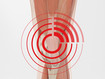 The painful area in the case of patellofemoral pain syndrome 