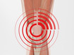 Point douloureux du syndrome douloureux fémoro-patellaire 