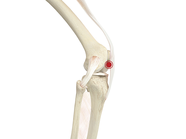 Patellaspitzensyndrom Schmerzpunkt Patellaspitzensyndrom