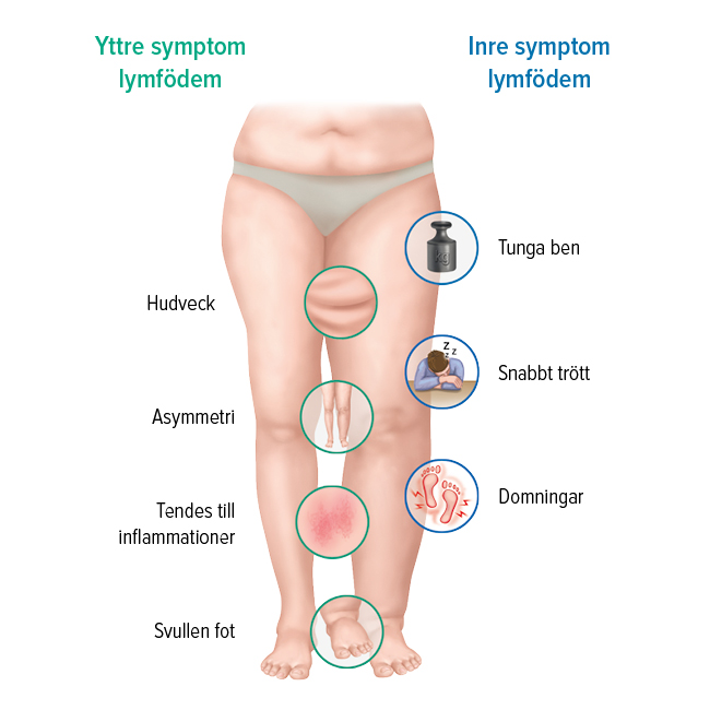 Symptomen för lymfödem Symptomen för lymfödem