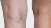 Legs with spider veins