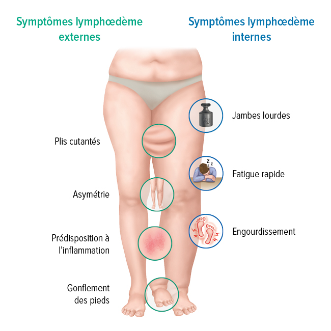 Les symptômes d'un lymphœdème Les symptômes d'un lymphœdème