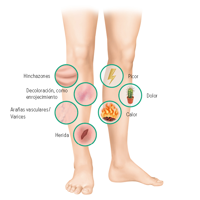 Síntomas de una pierna ulcerada