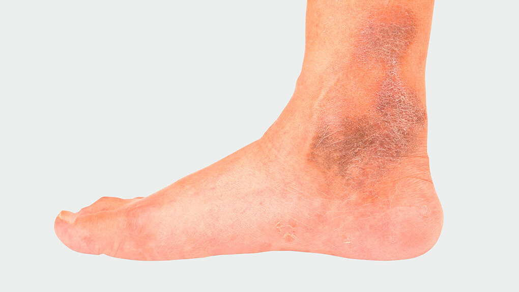 CVI Foot with chronic venous insufficiency