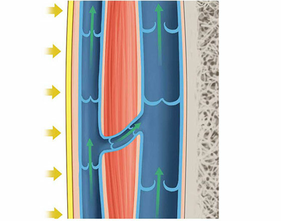 Vein with compression Vein with compression