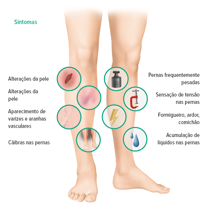 Sintomas da IVC Sintomas da IVC