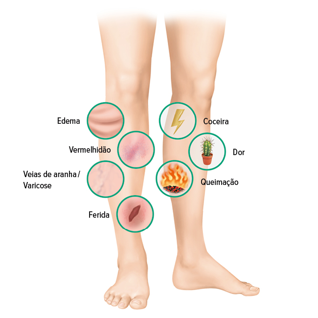 Úlcera venosa – Sintomas