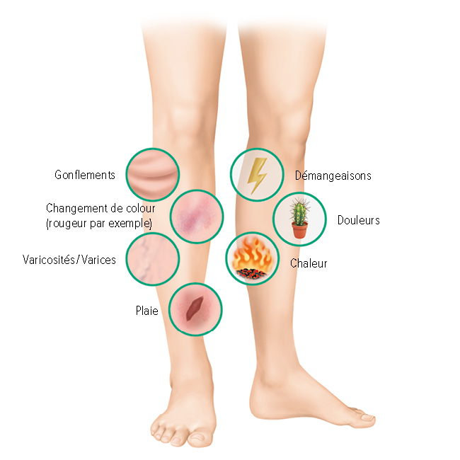 Symptômes d'un ulcère de jambe Symptômes d'un ulcère de jambe