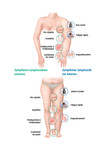 Les symptômes d'un lymphœdème