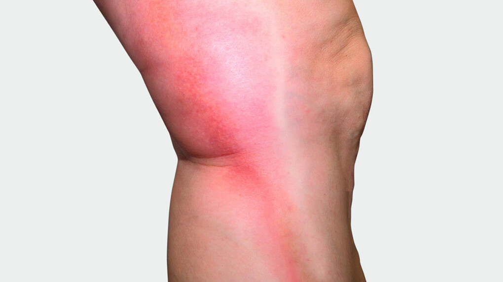 Mainteaser Thrombose Beine mit rotem Strang auf der Seite