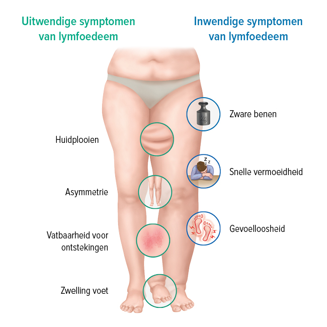De symptomen van een lymfoedeem