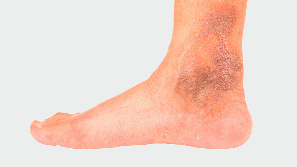 Mainteaser IVC Jambe Avec IVC