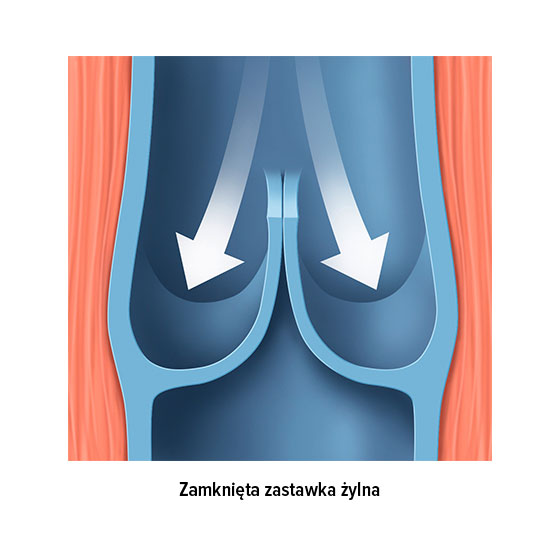 zamknięta zastawka żylna zamknięta zastawka żylna