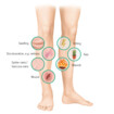 Symptoms of venous leg ulcers