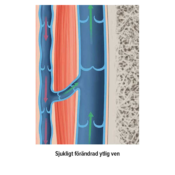 Sjukligt förändrad ytlig ven Sjukligt förändrad ytlig ven