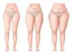 Diagram showing the stages of lipoedema