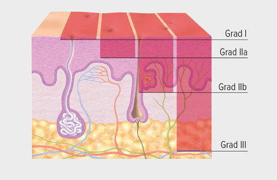 Brandnarben richtig behandeln