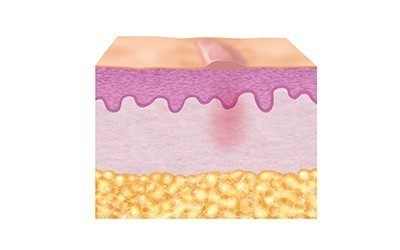 3. Reparatiefase (epithelisatie)