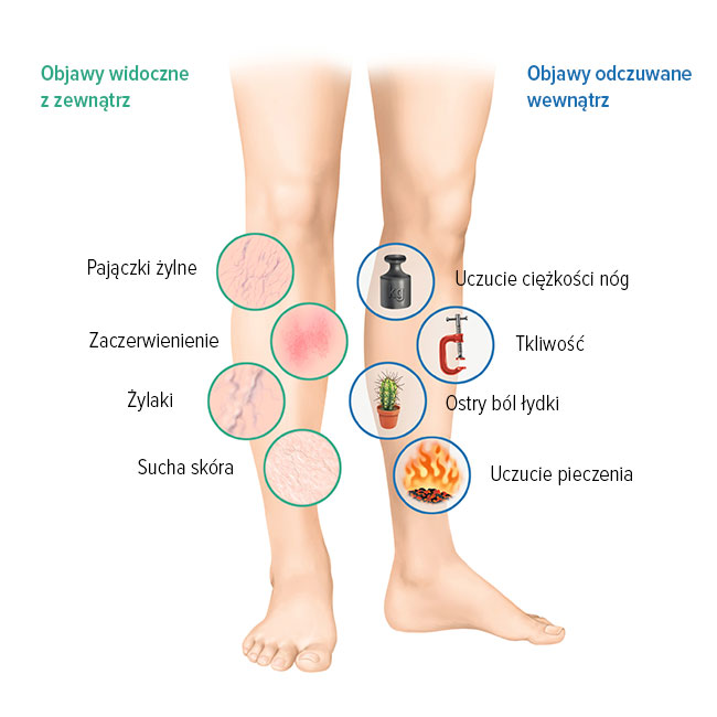 Objawy dolegliwości żylnych
