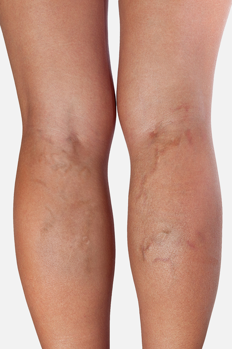 Bagsiden af benet, hvor man kan se åreknuder Bagsiden af benet, hvor man kan se åreknuder