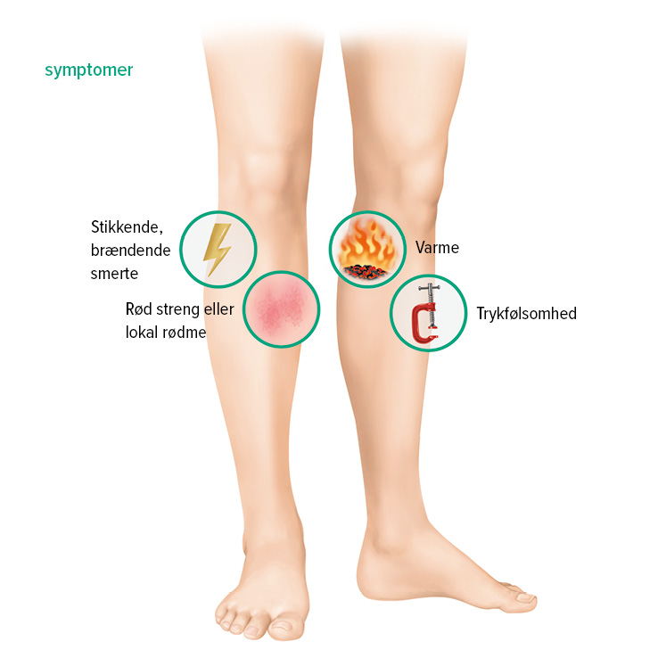 Symptomer på overfladisk venetrombose Symptomer på overfladisk venetrombose