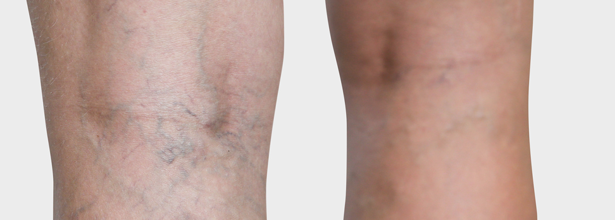 Spider veins Spider veins