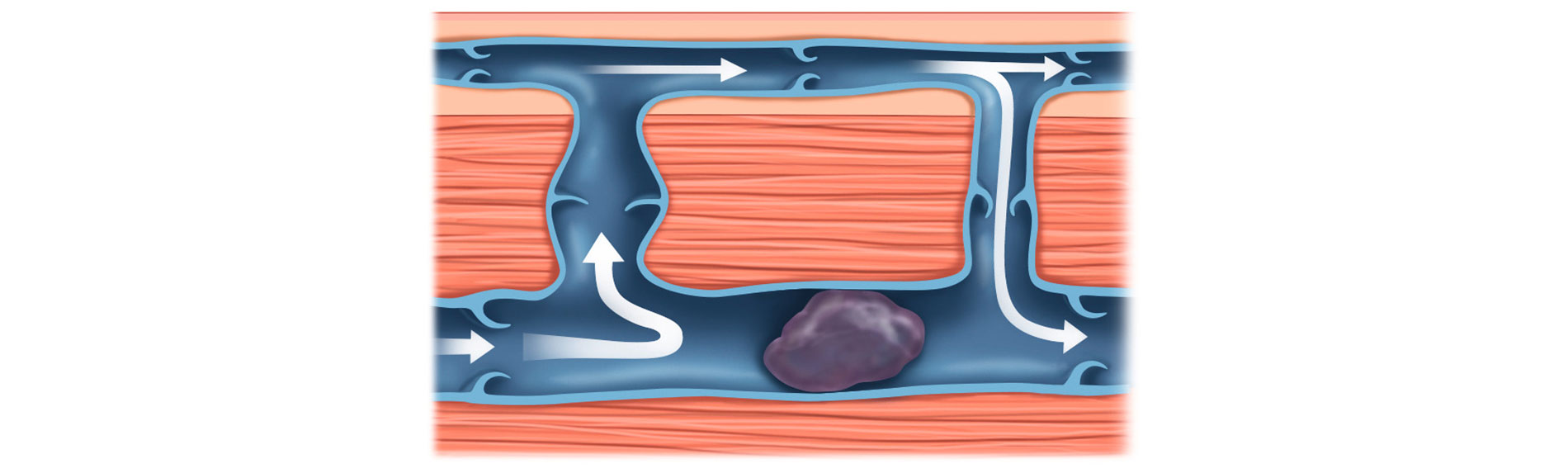 Thrombose: Gefahr erkannt, Gefahr gebannt