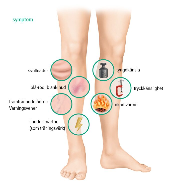 Symptom djup ventrombos Symptom djup ventrombos