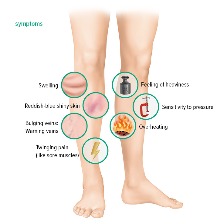 Symptoms of deep vein thrombosis