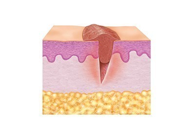 2. Granulatiefase van de huid (proliferatiefase)