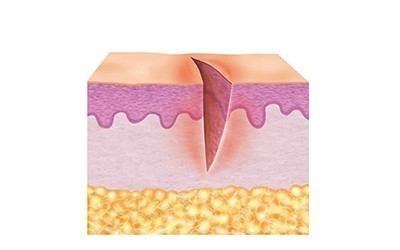 1. Reinigingsfase van de huid (ontstekingsfase)