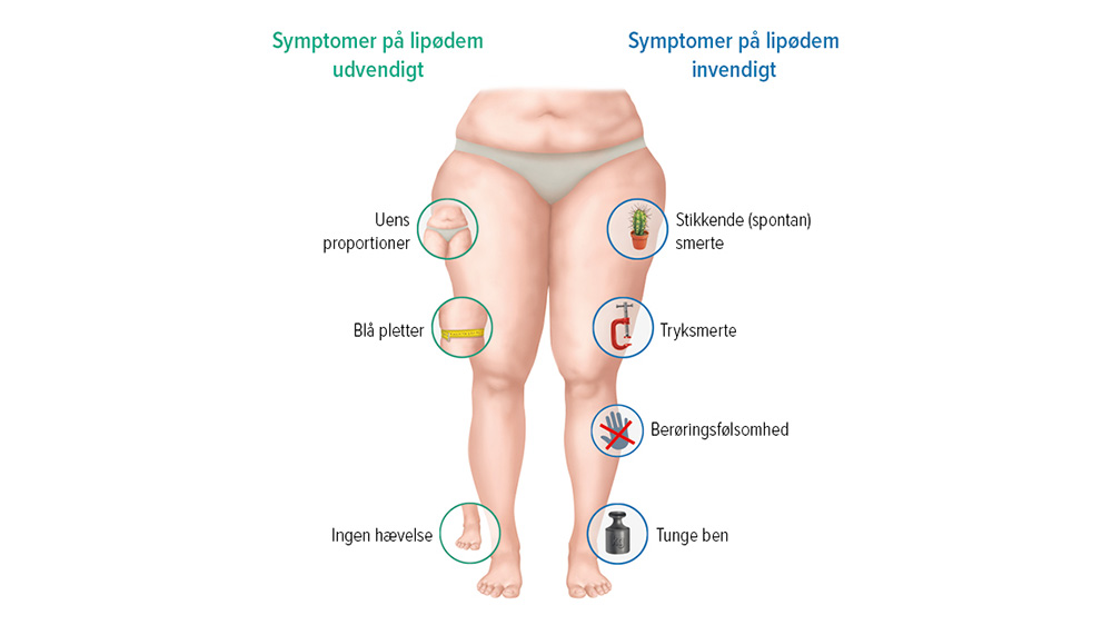 Grafik over symptomer ved lipødem