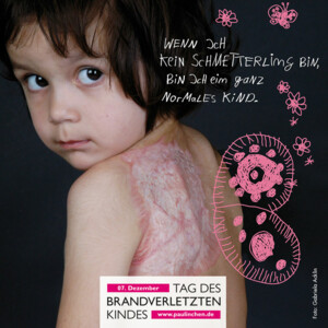Mädchen mit Brandverletzungen